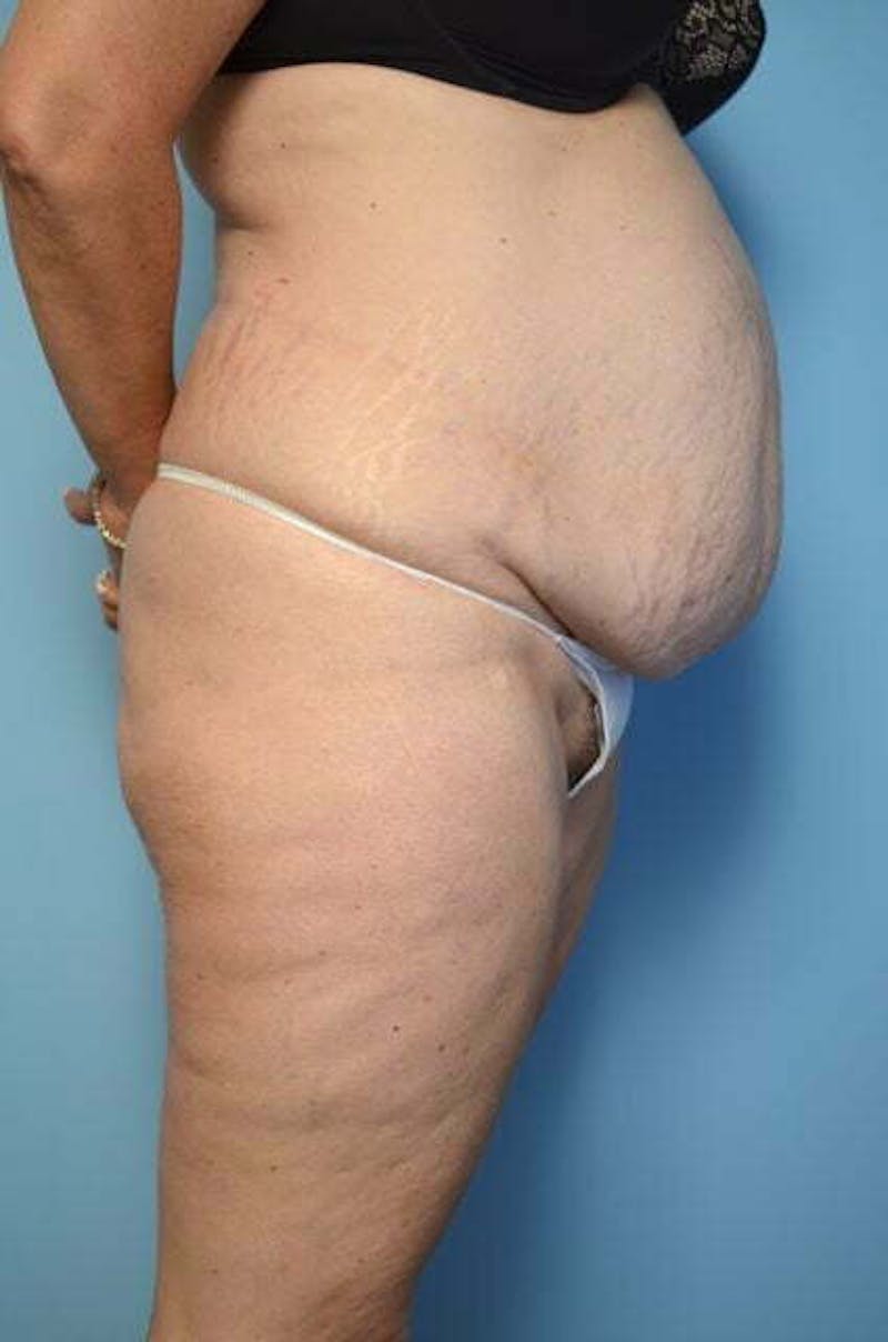 Liposuction Before & After Gallery - Patient 172464 - Image 5