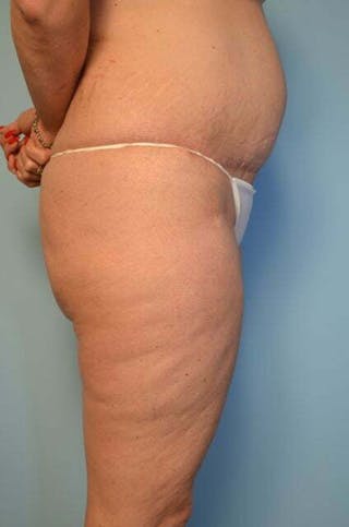 Liposuction Before & After Gallery - Patient 172464 - Image 6