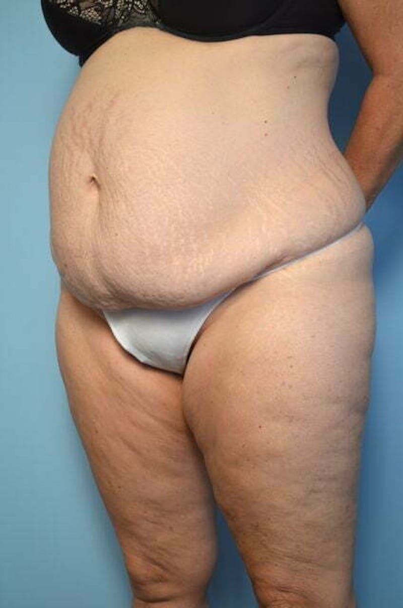 Liposuction Before & After Gallery - Patient 172464 - Image 7