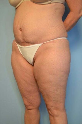 Liposuction Before & After Gallery - Patient 172464 - Image 8