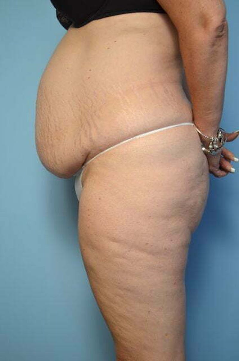 Liposuction Before & After Gallery - Patient 172464 - Image 9