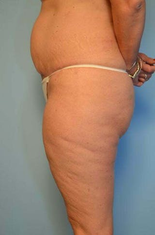 Liposuction Before & After Gallery - Patient 172464 - Image 10