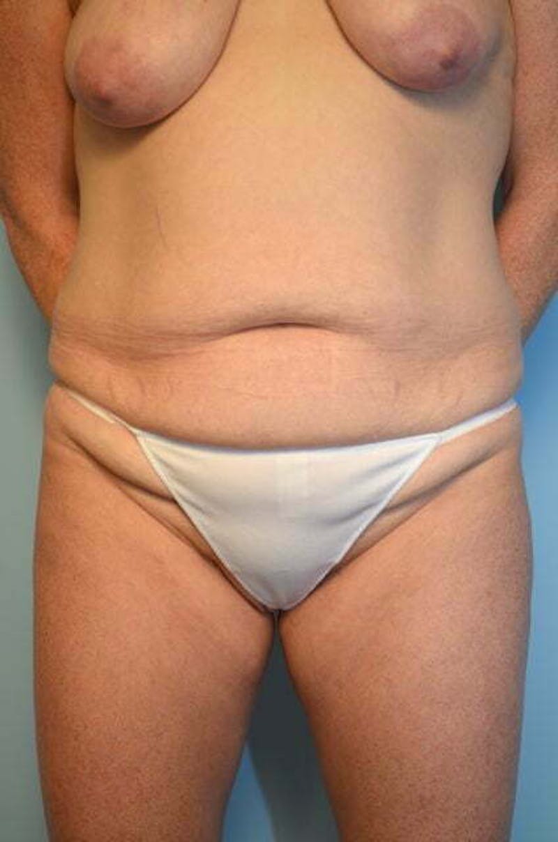 Tummy Tuck Before & After Gallery - Patient 340754 - Image 1