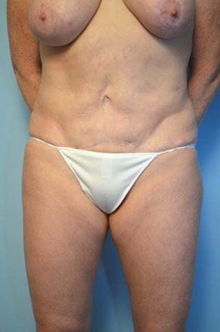 Tummy Tuck Before & After Gallery - Patient 340754 - Image 2