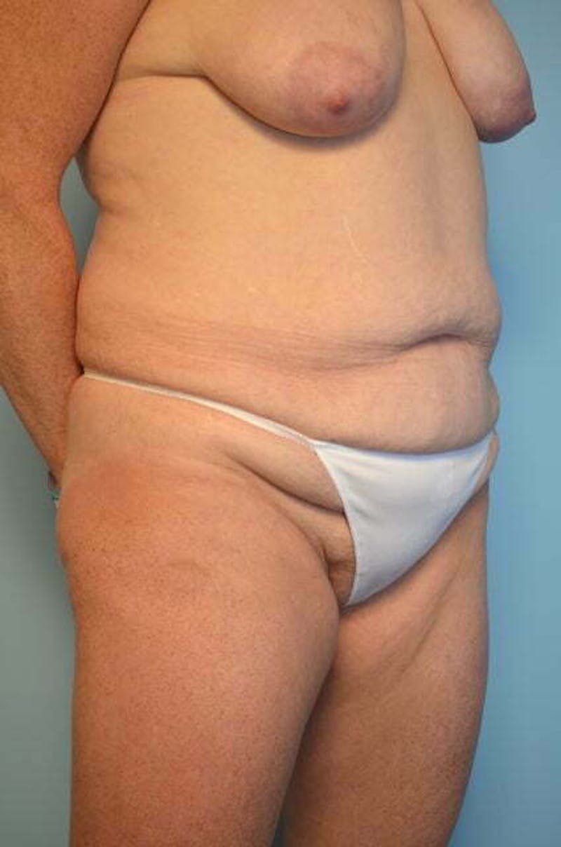 Tummy Tuck Before & After Gallery - Patient 340754 - Image 3