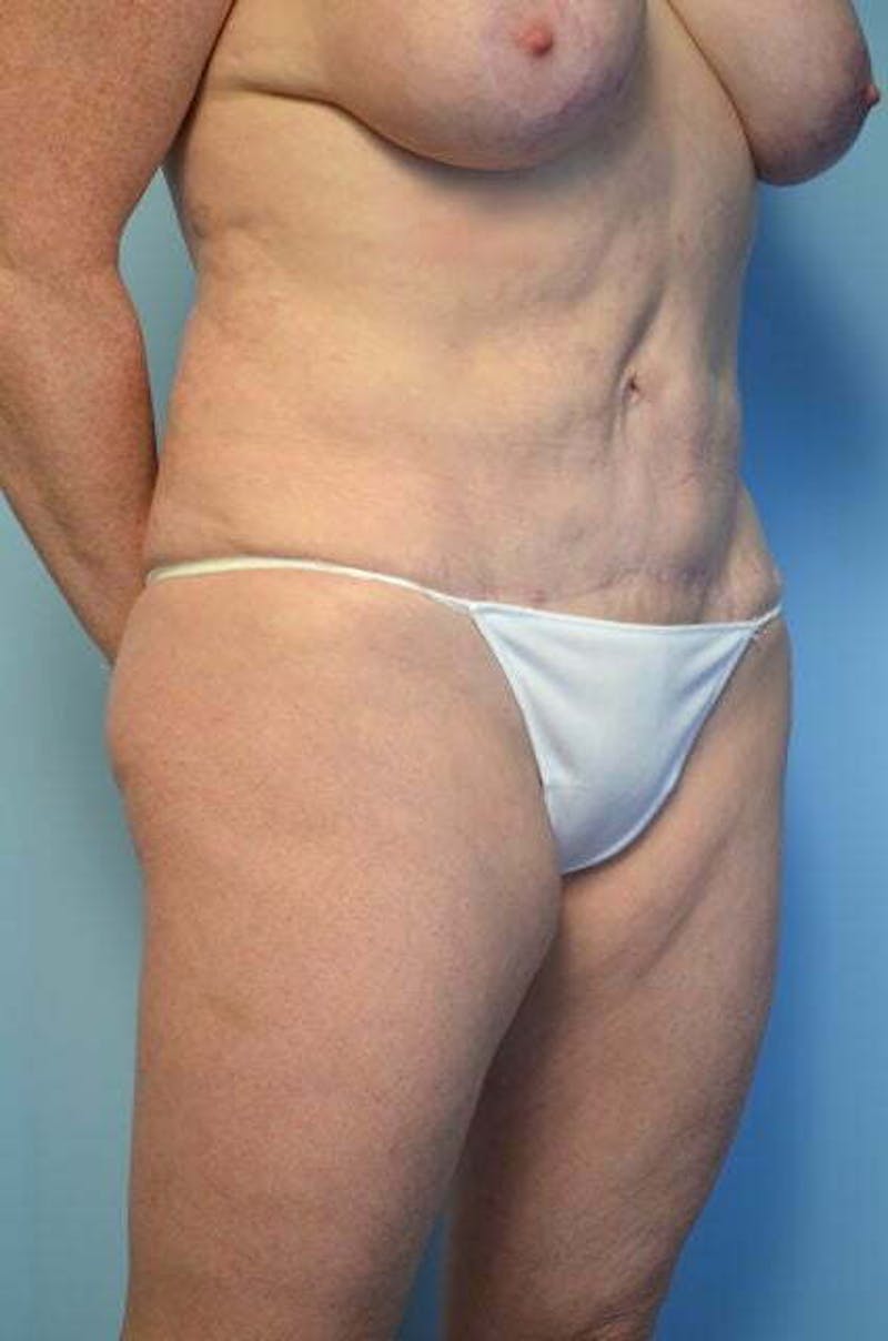 Tummy Tuck Before & After Gallery - Patient 340754 - Image 4