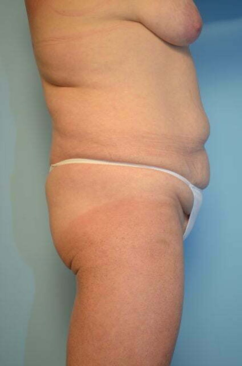 Tummy Tuck Before & After Gallery - Patient 340754 - Image 5