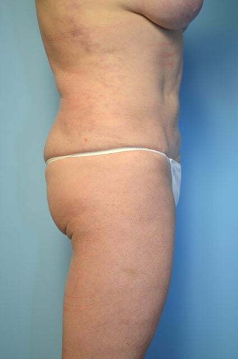 Tummy Tuck Before & After Gallery - Patient 340754 - Image 6