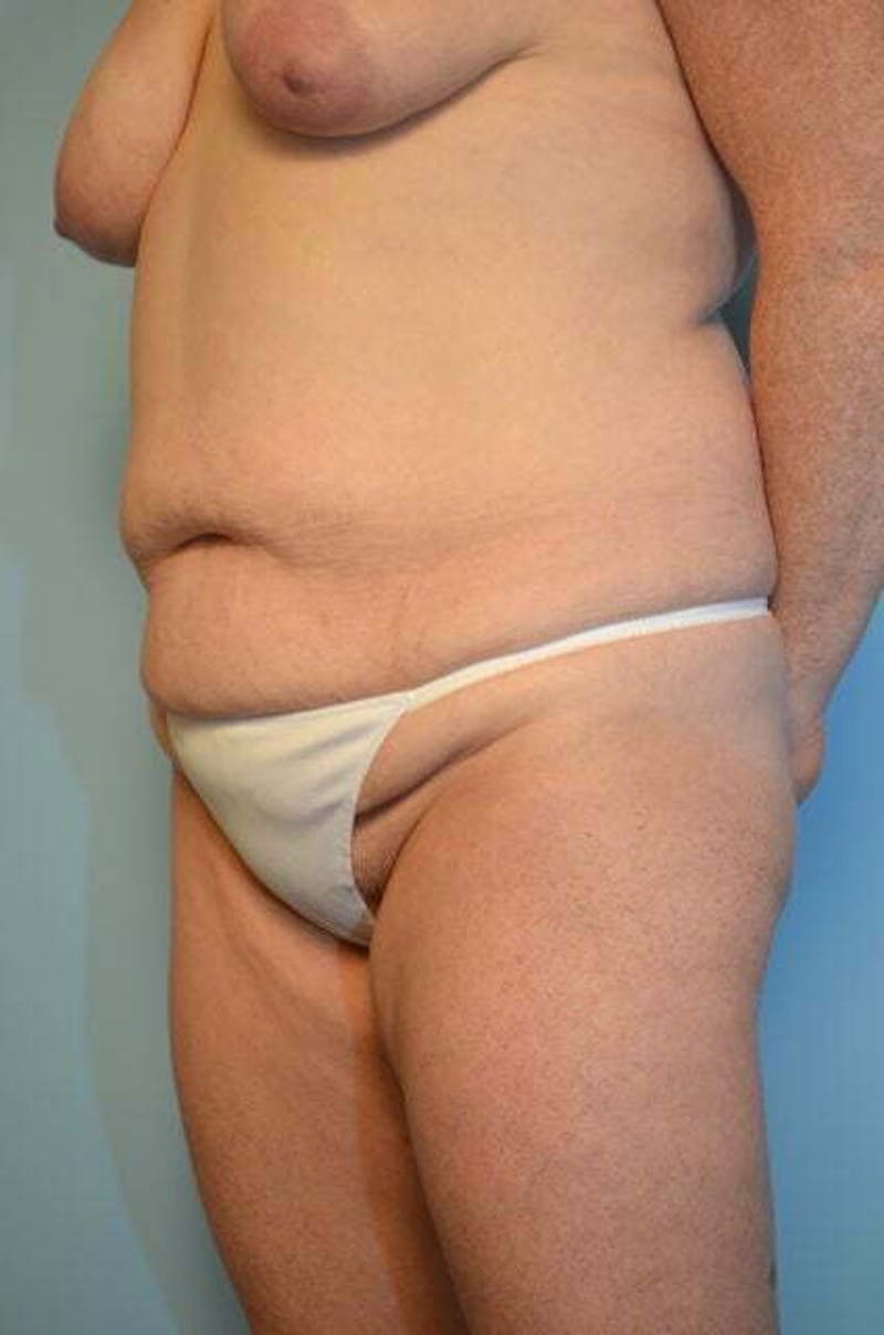Tummy Tuck Before & After Gallery - Patient 340754 - Image 7