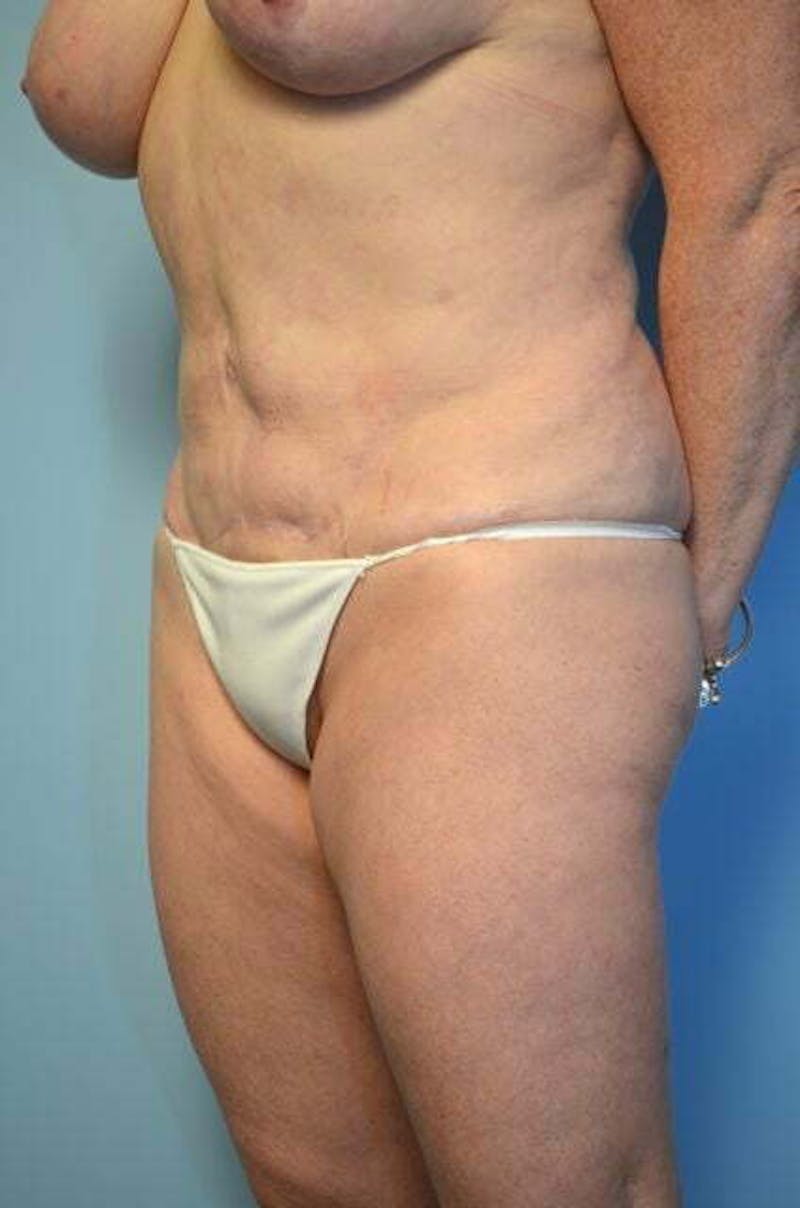 Tummy Tuck Before & After Gallery - Patient 340754 - Image 8