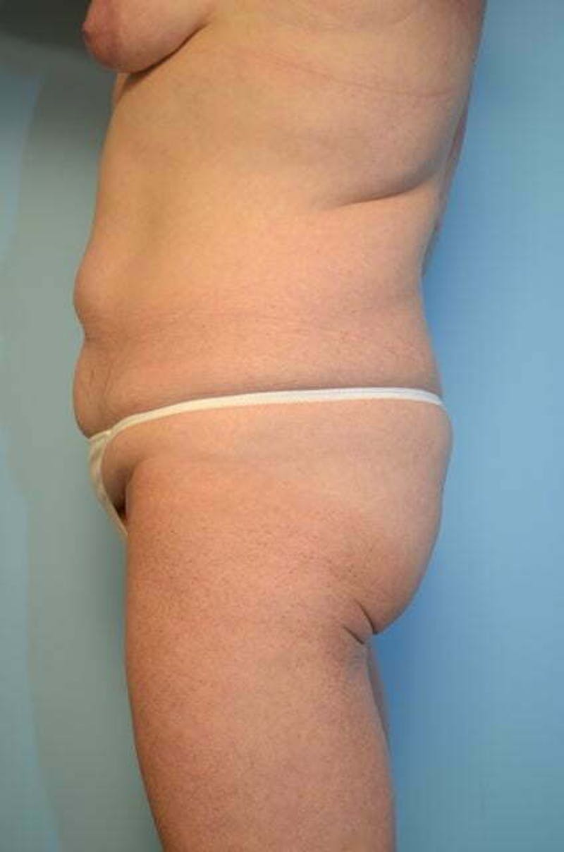 Tummy Tuck Before & After Gallery - Patient 340754 - Image 9