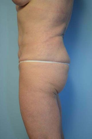 Tummy Tuck Before & After Gallery - Patient 340754 - Image 10