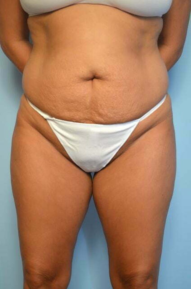 Liposuction Before & After Gallery - Patient 414596 - Image 1