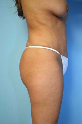 Liposuction Before & After Gallery - Patient 414596 - Image 6