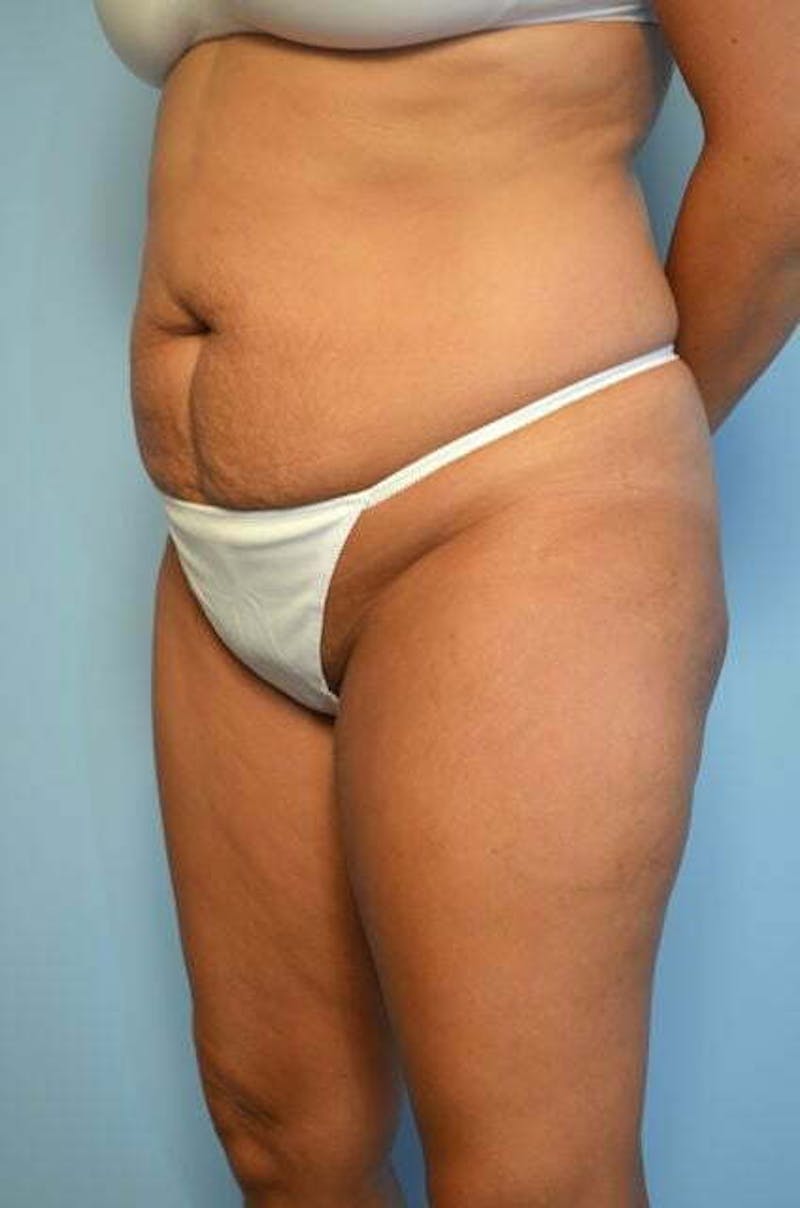 Liposuction Before & After Gallery - Patient 414596 - Image 7