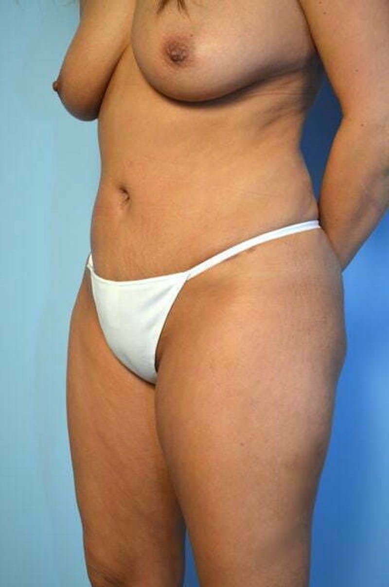 Liposuction Before & After Gallery - Patient 414596 - Image 8