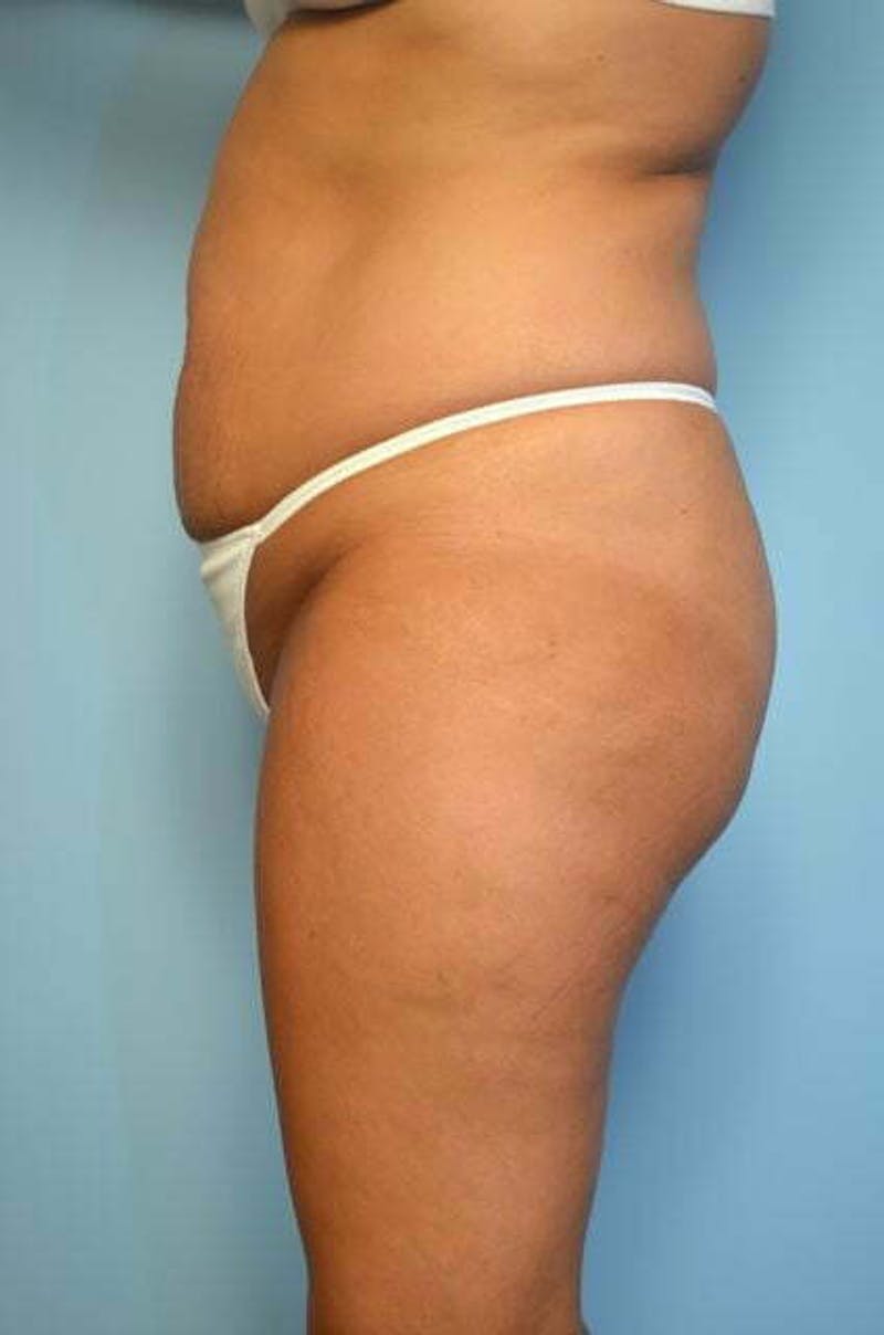 Liposuction Before & After Gallery - Patient 414596 - Image 9