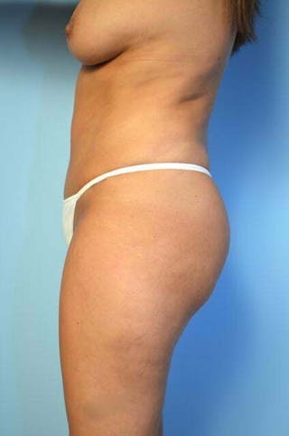 Liposuction Before & After Gallery - Patient 414596 - Image 10