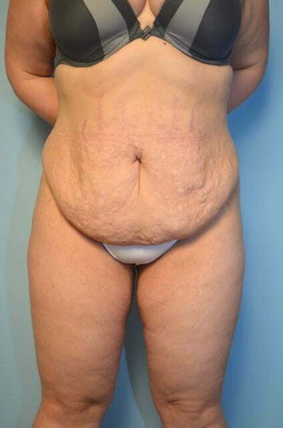 Liposuction Before & After Gallery - Patient 325458 - Image 1