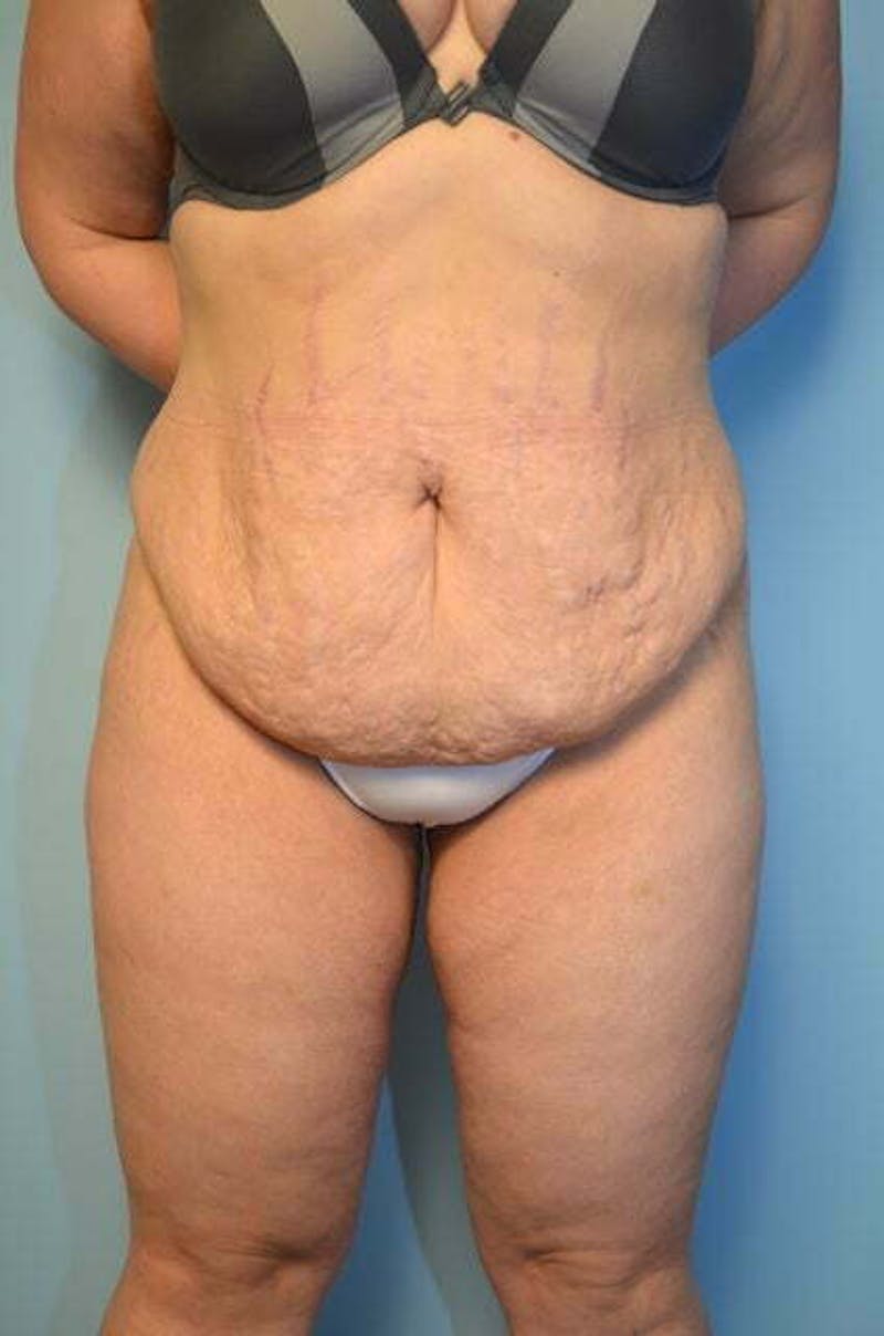 Tummy Tuck Before & After Gallery - Patient 414962 - Image 1