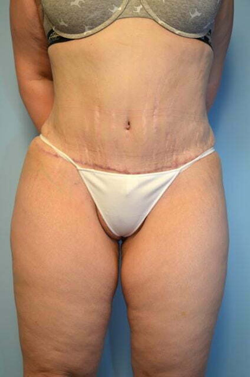 Tummy Tuck Before & After Gallery - Patient 414962 - Image 2