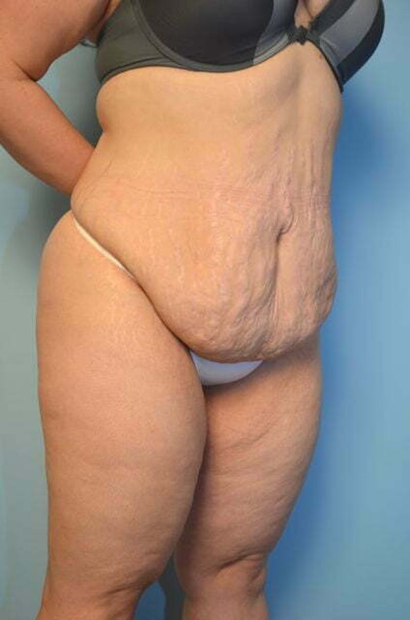 Tummy Tuck Before & After Gallery - Patient 414962 - Image 3
