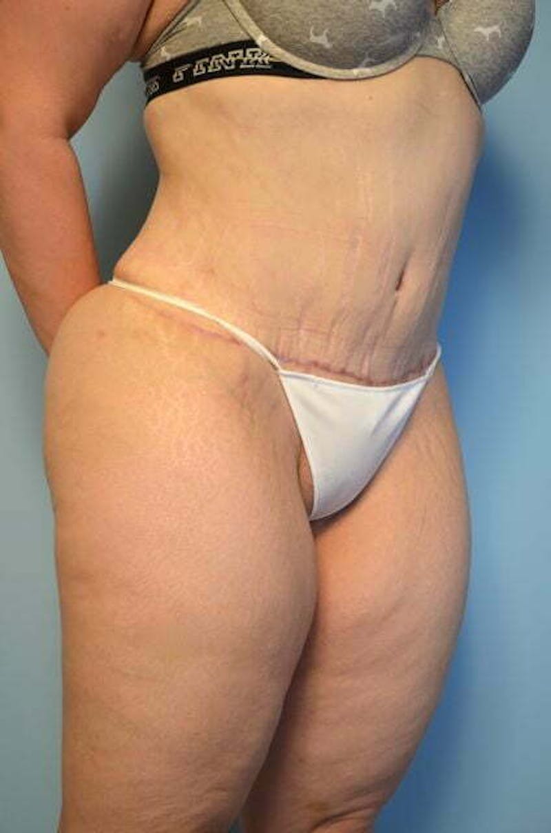 Tummy Tuck Before & After Gallery - Patient 414962 - Image 4