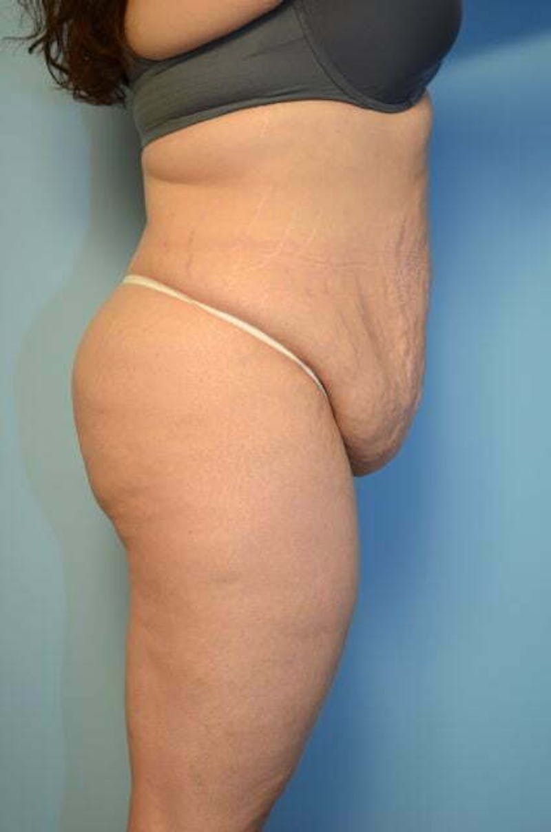 Tummy Tuck Before & After Gallery - Patient 414962 - Image 5