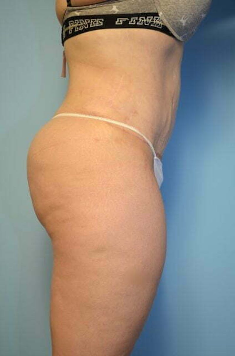 Tummy Tuck Before & After Gallery - Patient 414962 - Image 6
