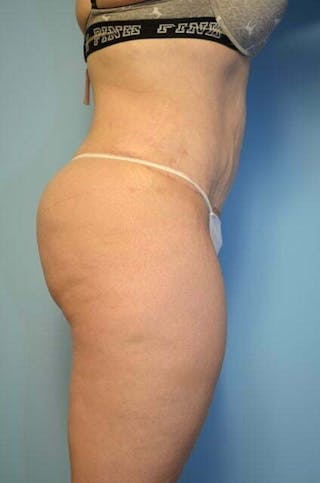 Liposuction Before & After Gallery - Patient 325458 - Image 6