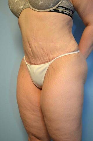 Liposuction Before & After Gallery - Patient 325458 - Image 8