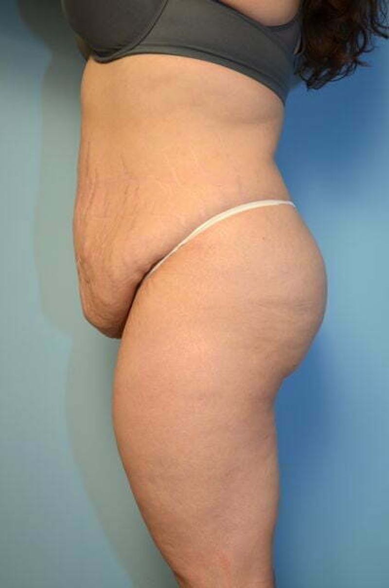 Tummy Tuck Before & After Gallery - Patient 414962 - Image 9