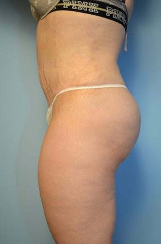 Liposuction Before & After Gallery - Patient 325458 - Image 10