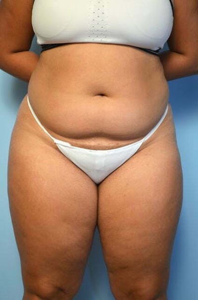 Liposuction Before & After Gallery - Patient 131071 - Image 1