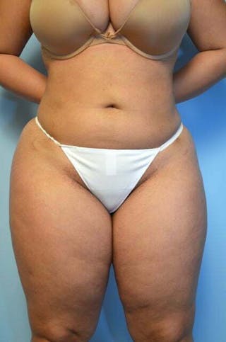 Tummy Tuck Before & After Gallery - Patient 275187 - Image 2