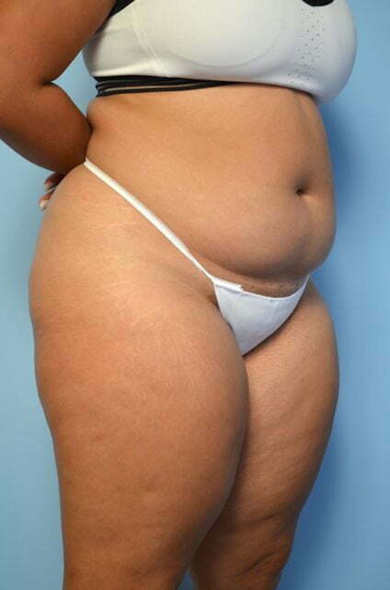 Tummy Tuck Before & After Gallery - Patient 275187 - Image 3