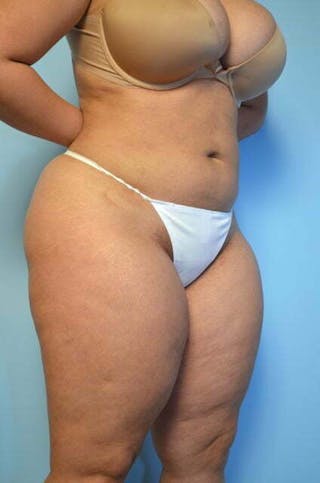 Tummy Tuck Before & After Gallery - Patient 275187 - Image 4