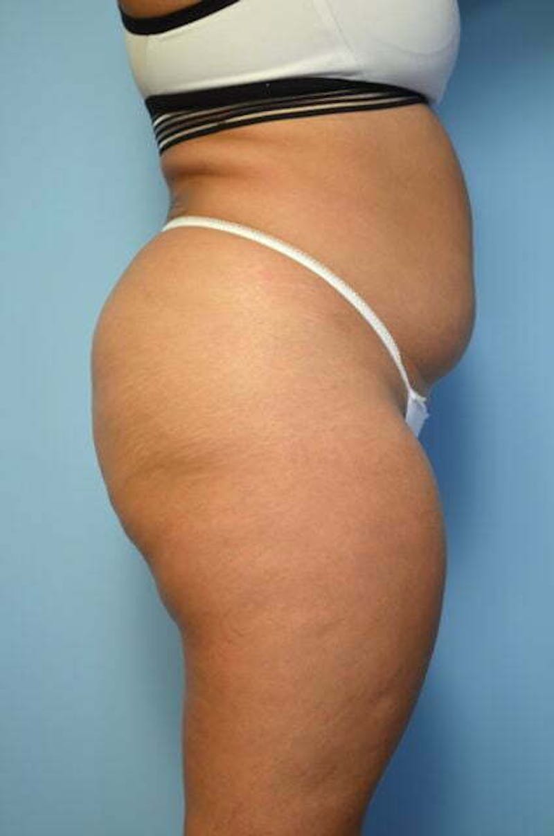 Tummy Tuck Before & After Gallery - Patient 275187 - Image 5