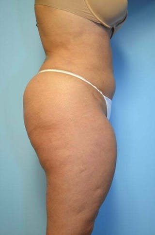Tummy Tuck Before & After Gallery - Patient 275187 - Image 6