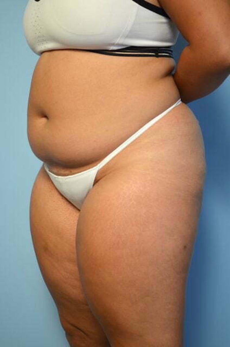 Tummy Tuck Before & After Gallery - Patient 275187 - Image 7