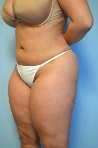 Tummy Tuck Before & After Gallery - Patient 275187 - Image 8