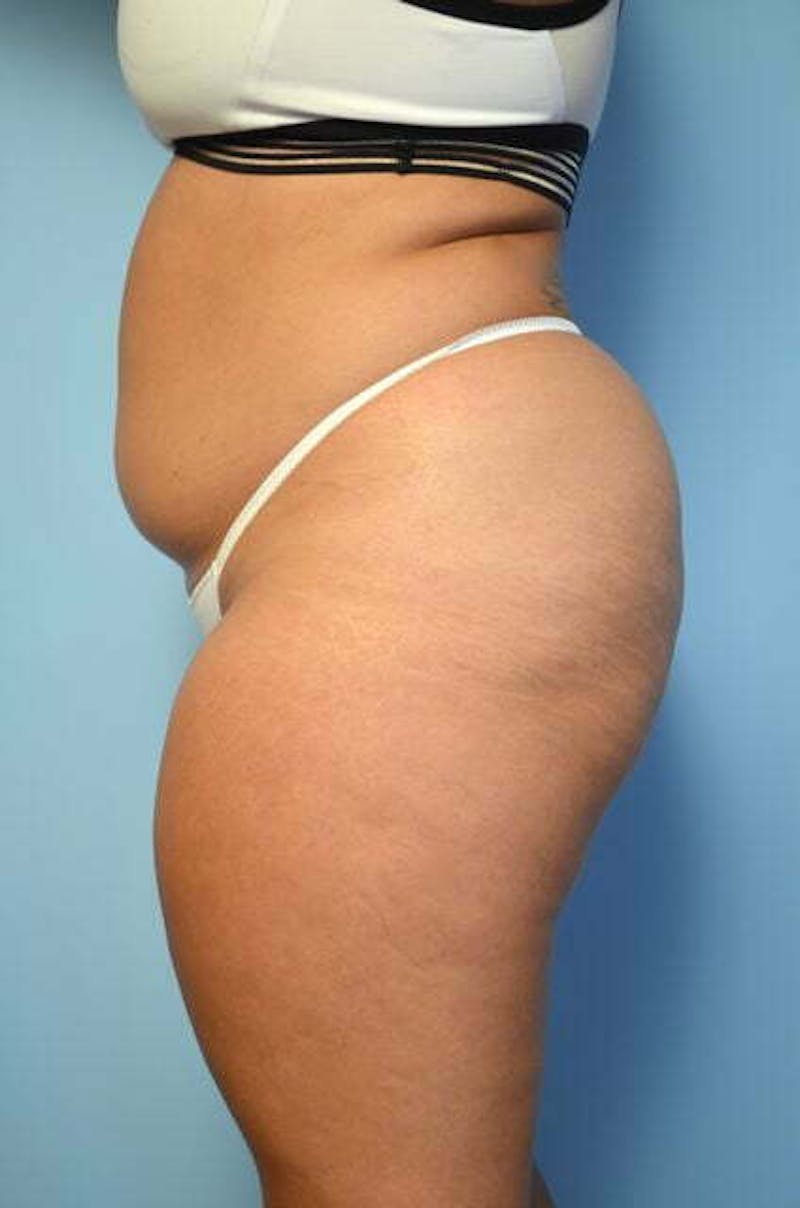 Tummy Tuck Before & After Gallery - Patient 275187 - Image 9