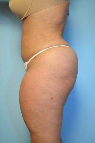 Tummy Tuck Before & After Gallery - Patient 275187 - Image 10