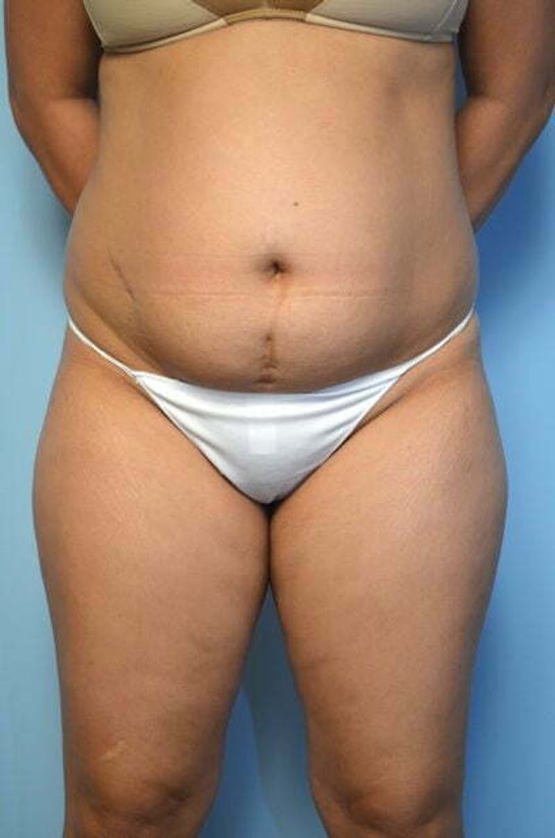 Tummy Tuck Before & After Gallery - Patient 344965 - Image 1
