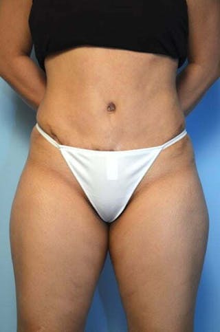 Tummy Tuck Before & After Gallery - Patient 344965 - Image 2
