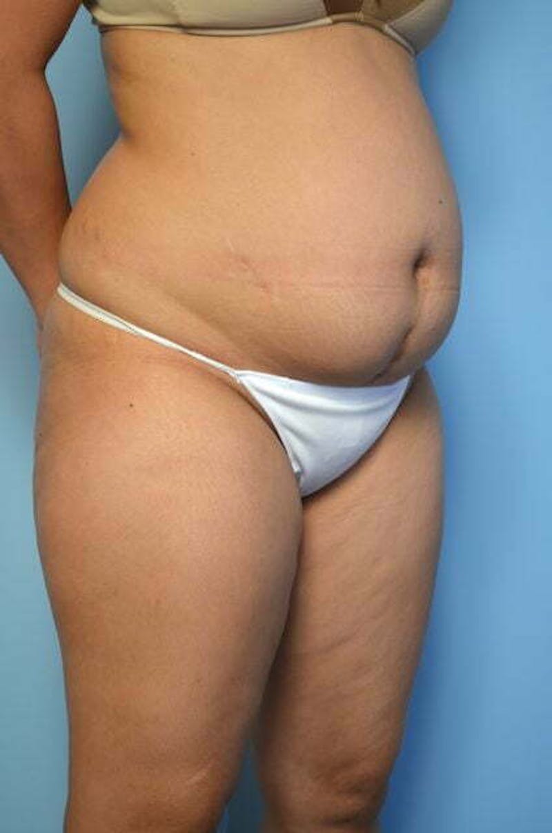 Tummy Tuck Before & After Gallery - Patient 344965 - Image 3