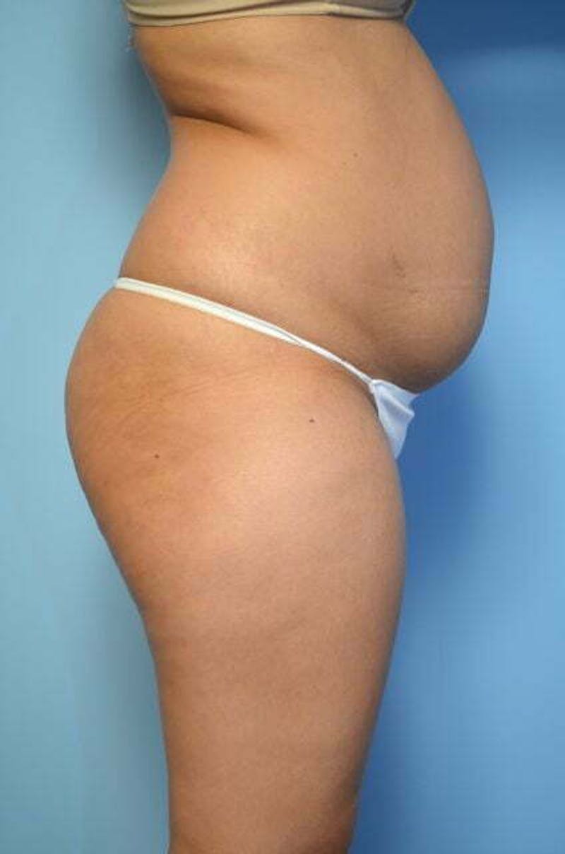 Tummy Tuck Before & After Gallery - Patient 344965 - Image 5