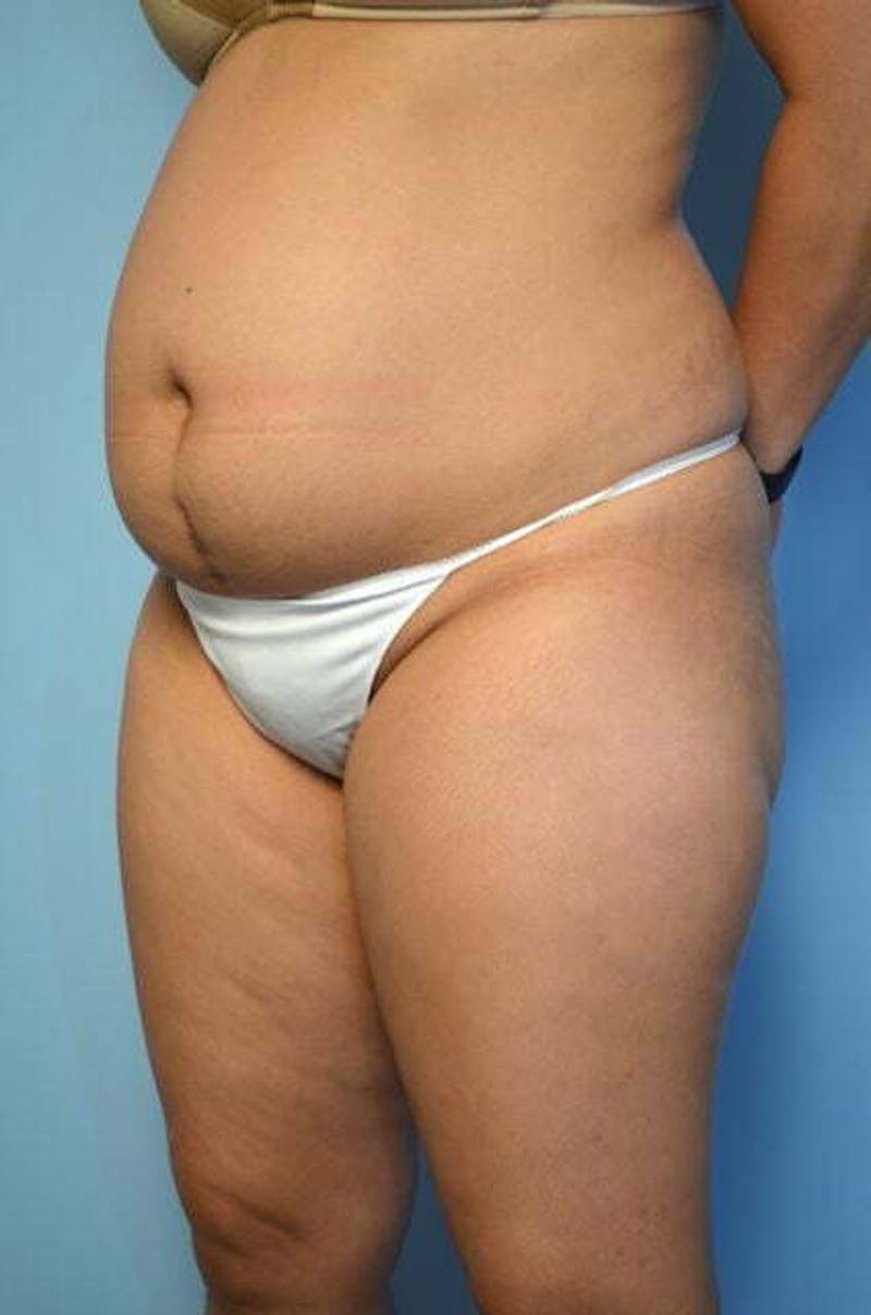 Tummy Tuck Before & After Gallery - Patient 344965 - Image 7