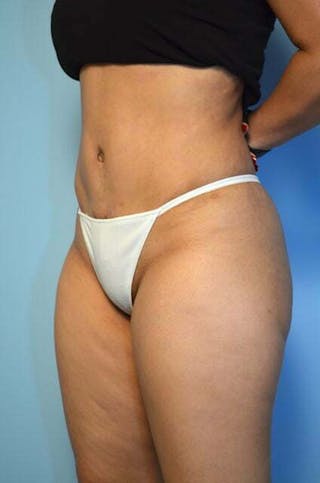 Tummy Tuck Before & After Gallery - Patient 344965 - Image 8