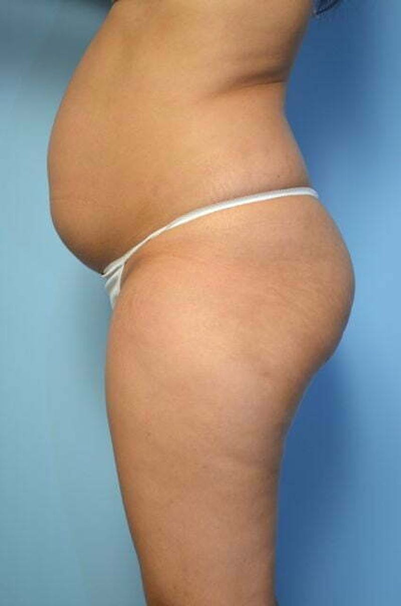 Tummy Tuck Before & After Gallery - Patient 344965 - Image 9